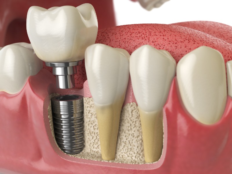 Dental implants procedure by dentist near me in Little Elm TX
