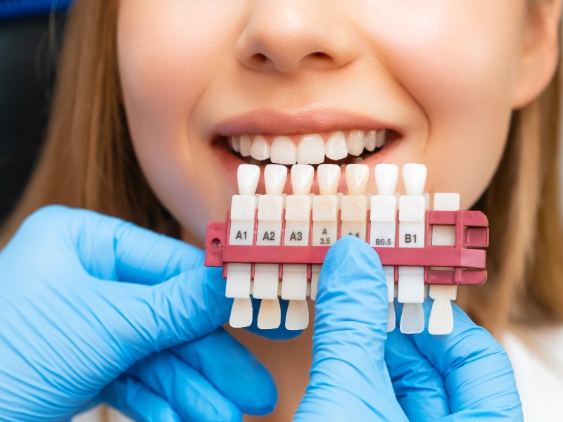 Professional teeth whitening by dentist near me in Little Elm TX