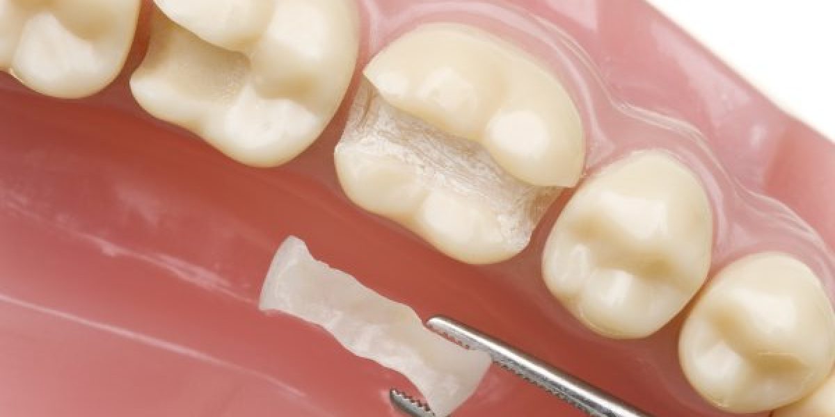 dental-bonding20162