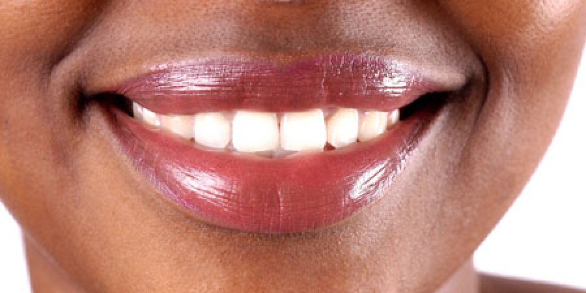 dental-extractions201685