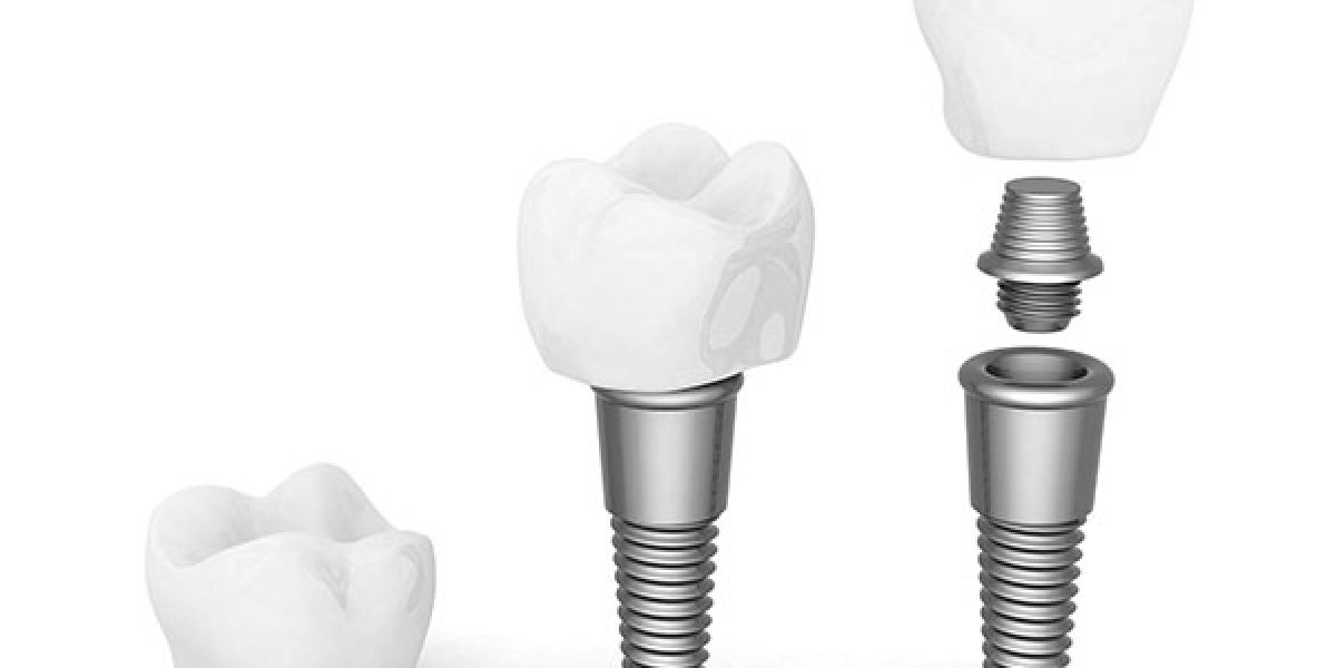 dental-implants201512