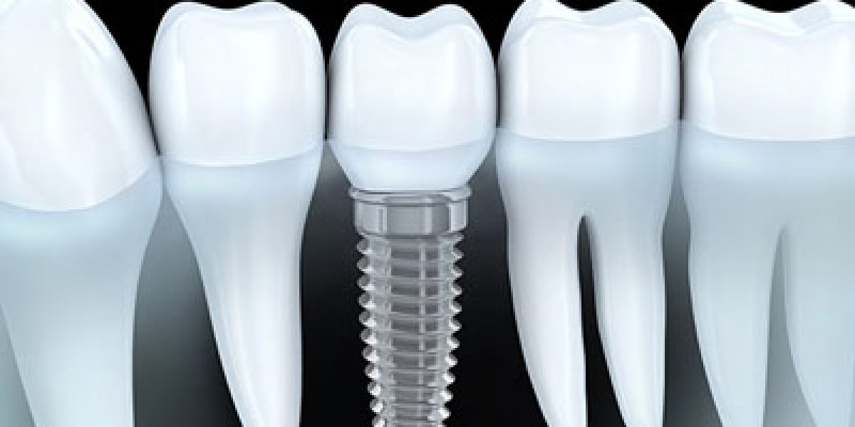dental-implants201612