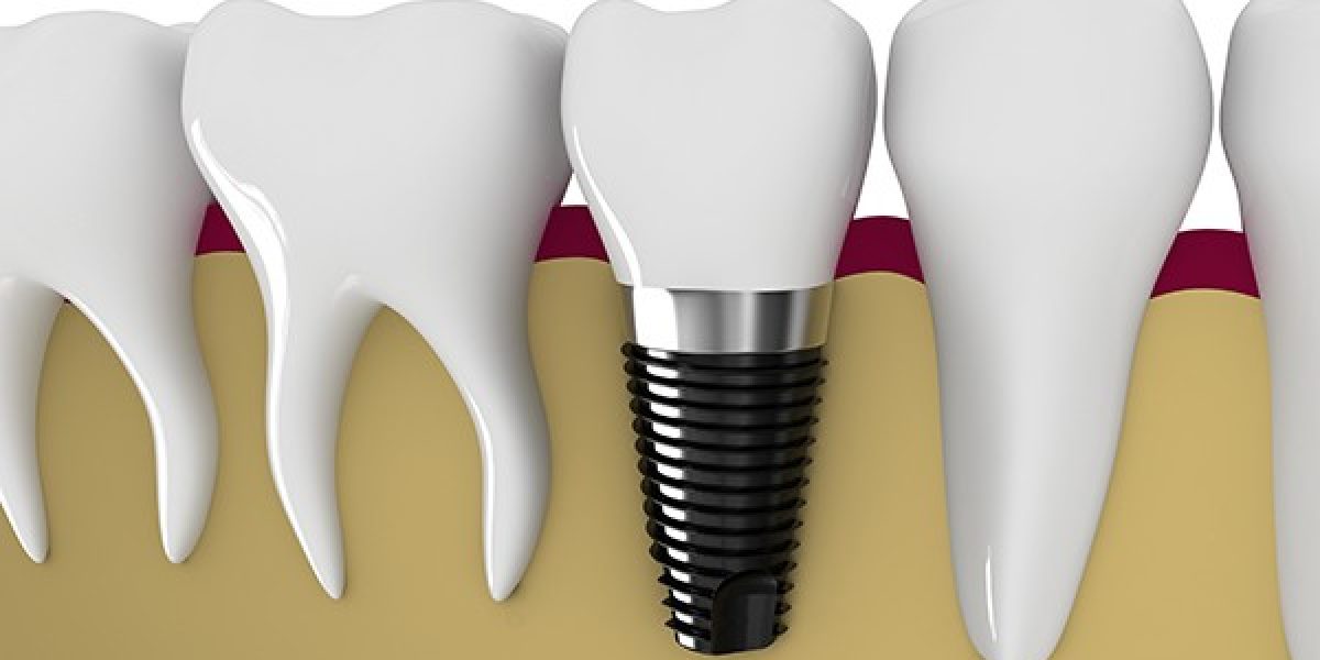 dental-implants20163